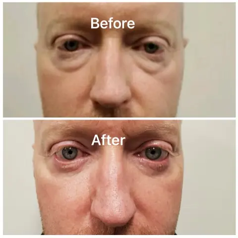 Before-After-a