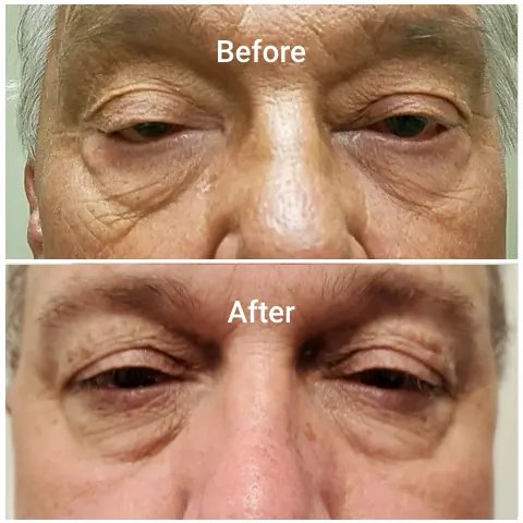 Before-After-b