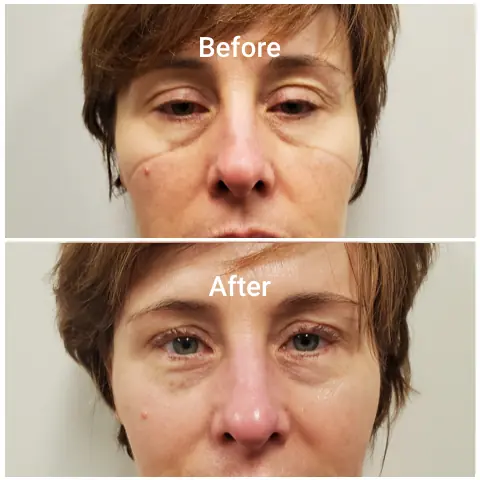 Before-After-c