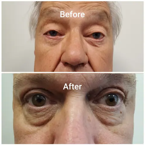 Before-After-d