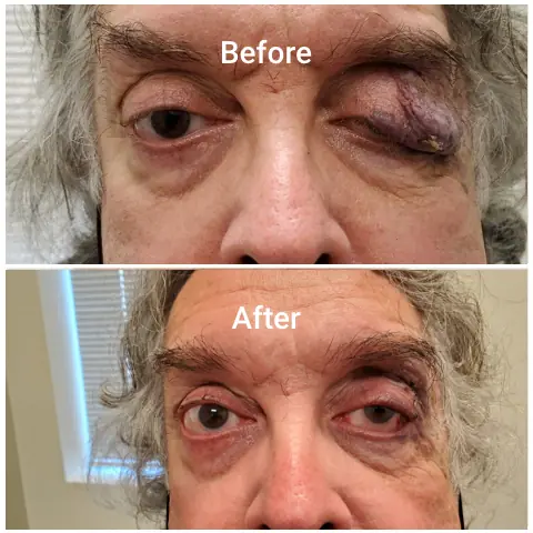 Before-After-e