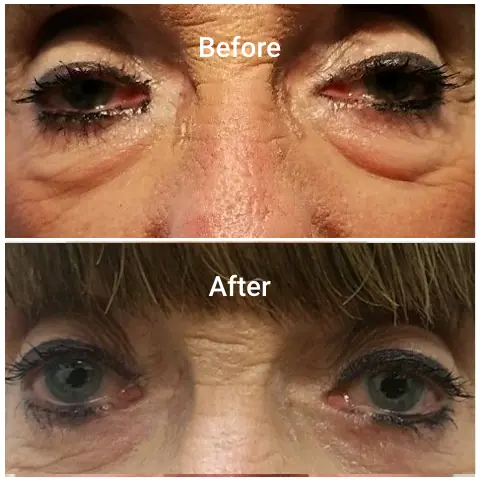 Before-After-f-
