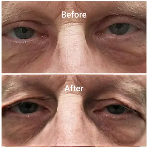 Before-After-g
