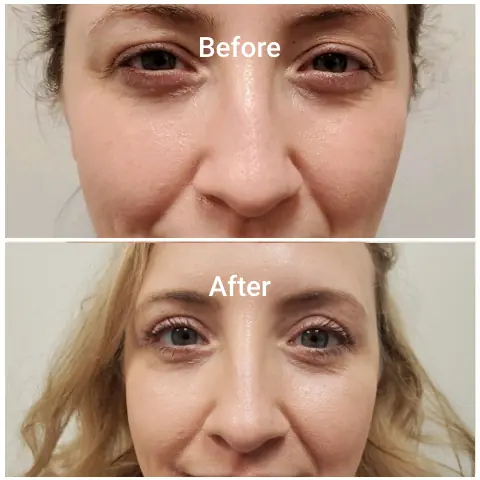 Before-After-h