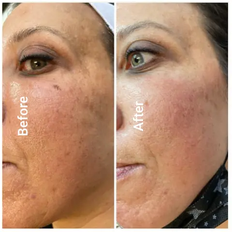 Before-After-i